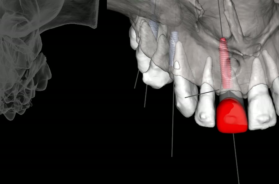 Planejamento digital de um implante unitário, com o dente em destaque